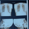 Inkjet Blue Medical X-Ray Film