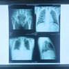Medical Thermal Blue X-Ray Film for Digital Medical Dry Imaging